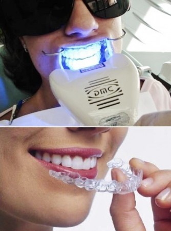 Clareamentos a Laser e Convencional