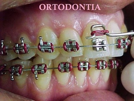 Aparelhos de Correção